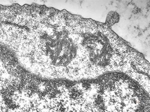 M,18y. | blood - tubular inclusions in lymphocytes